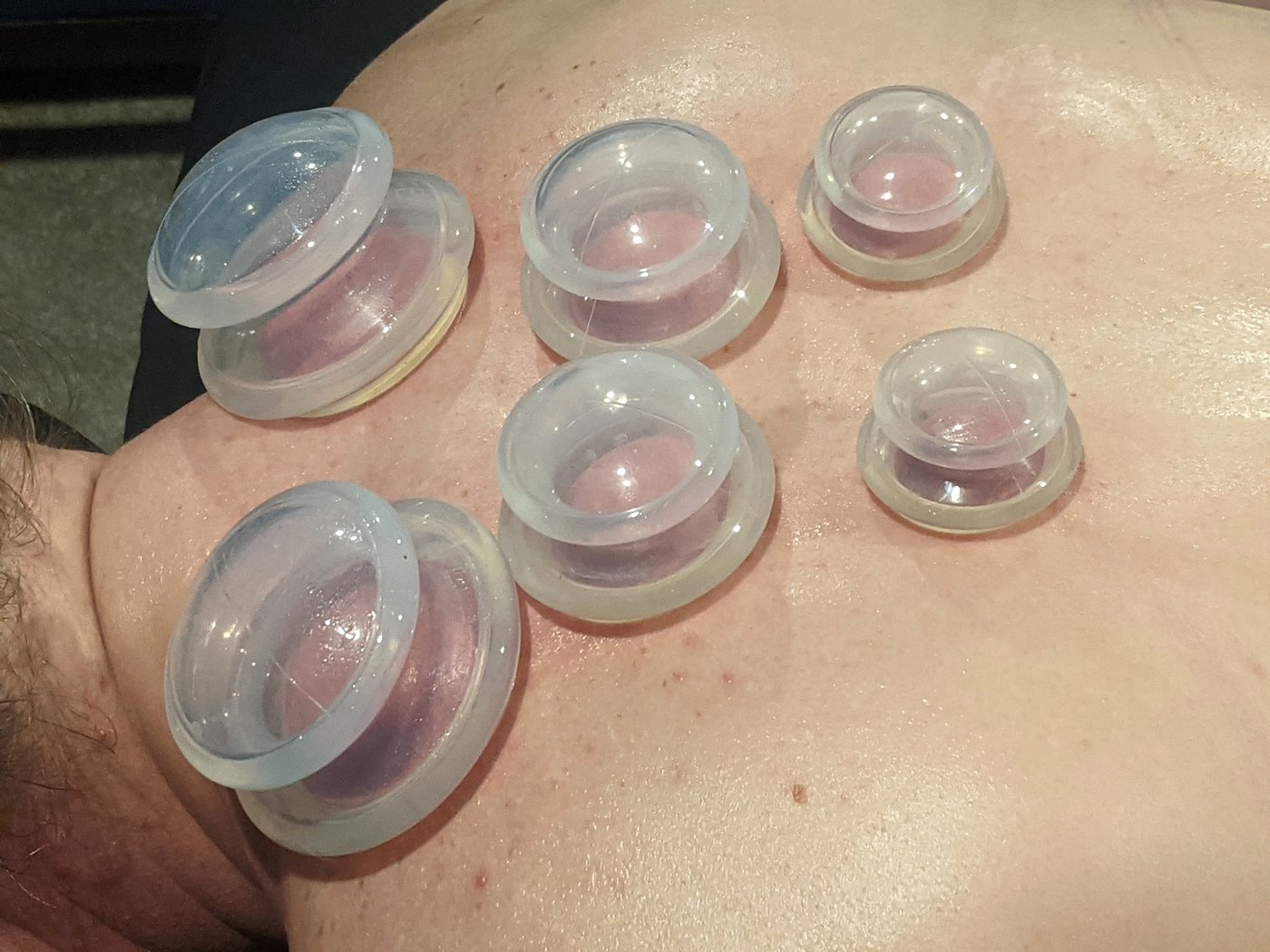 Cupping therapy